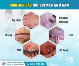 ảnh chụp màn hình bệnh viện da liễu có khám sùi mào gà không