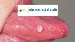 ảnh chụp màn hình chữa sùi mào gà ở bệnh viện da liễu