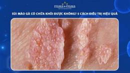 ảnh chụp màn hình có ai đã chữa khỏi sùi mào gà?