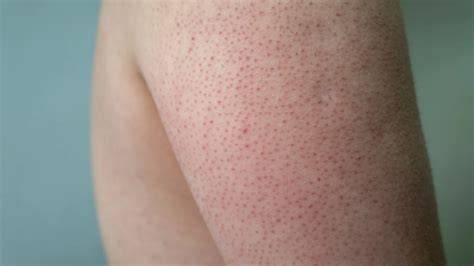 ảnh chụp màn hình da cổ bị nổi sần như da gà