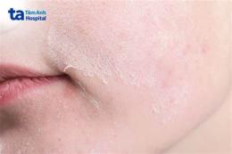 ảnh chụp màn hình da có sần sùi như da gà