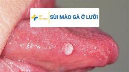 ảnh chụp màn hình đã lưỡi có bị sùi mào gà không