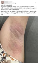 ảnh chụp màn hình nách bị da gà