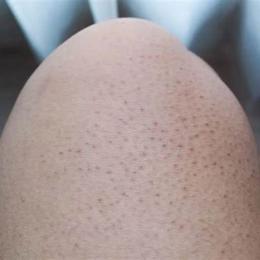 bị nổi da gà ở cổ