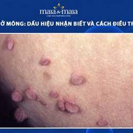 cách trị da gà ở mông