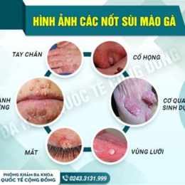 chữa sùi mào gà ở đà lạt