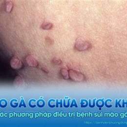 chữa sùi mào gà ở da liễu trung ương