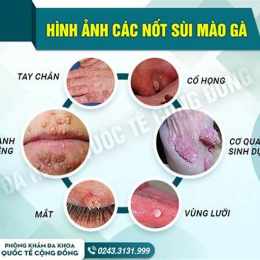 chữa sùi mào gà ở đà nẵng