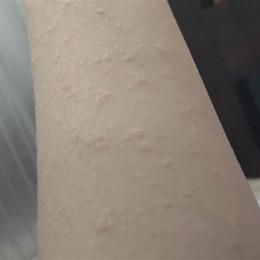 cổ nổi hạt li ti như da gà
