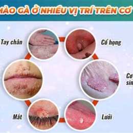 đã khỏi sùi mào gà có nên sinh thường