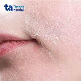 da mặt bị sần như da gà