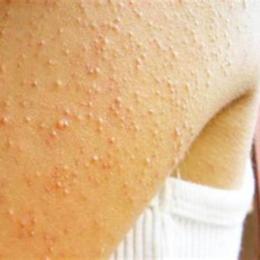 da nổi từng mảng như da gà