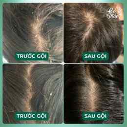gàu da đầu cận cảnh