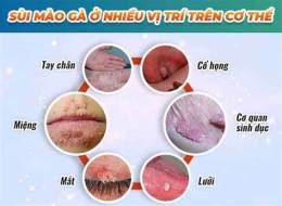 giao diện app đã khỏi sùi mào gà có nên sinh thường