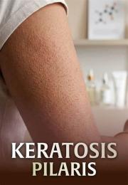 giao diện app keratosis pilaris da gà