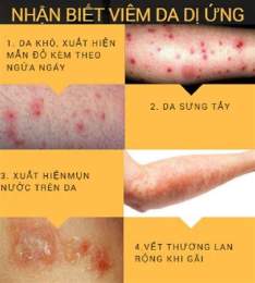 hướng dẫn sử dụng bệnh viêm da ở gà
