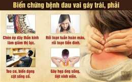 hướng dẫn sử dụng chèn ép dây thần kinh cổ gây tê tay