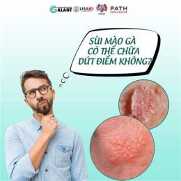 hướng dẫn sử dụng chữa sùi mào gà ở đà nẵng