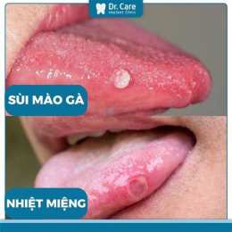 hướng dẫn sử dụng đã lưỡi có bị sùi mào gà không