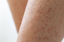 hướng dẫn sử dụng keratosis pilaris da gà