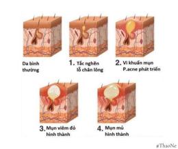 hướng dẫn sử dụng mụn sùi mào gà giai đoạn đầu