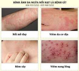 hướng dẫn sử dụng nổi mụn như da gà