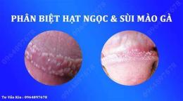 hướng dẫn sử dụng sùi mào gà giai đoạn đầu nam