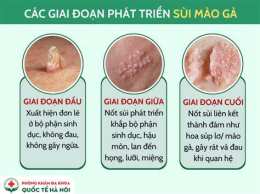 hướng dẫn sử dụng sùi mào gà mọc trên da đầu