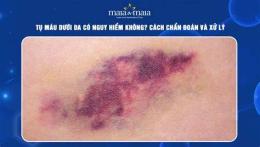 hướng dẫn sử dụng tụ máu dưới da chân gà