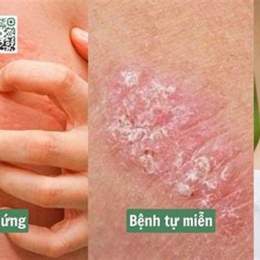 mẩn da gà