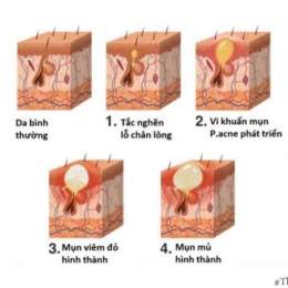 mụn sùi mào gà giai đoạn đầu