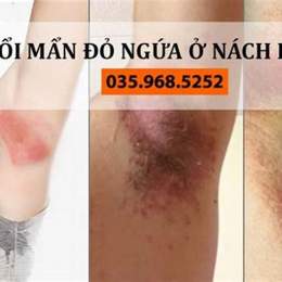 nách bị nổi da gà