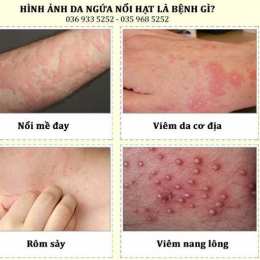 nổi da gà liên tức có sao không
