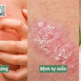 nổi mẩn da gà