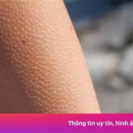 sốt nổi da gà có nên đắp chăn
