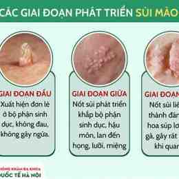 sùi mào gà mọc trên da đầu