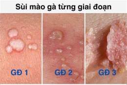 tính năng nổi bật ai đã từng bị sùi mào gà