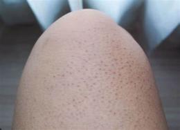 tính năng nổi bật chân bị nổi hột như da gà