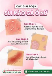 tính năng nổi bật chữa sùi mào gà ở bệnh viện da liễu