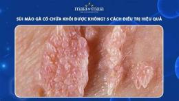 tính năng nổi bật đã khỏi sùi mào gà có nên sinh thường