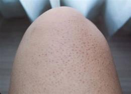 tính năng nổi bật da mặt bị nổi hột như da gà