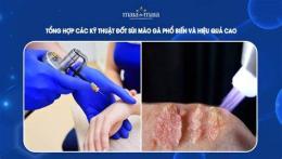 tính năng nổi bật đốt sùi mào gà, bệnh viện da liễu