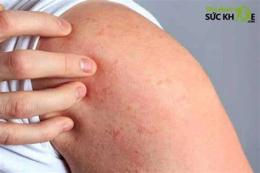 tính năng nổi bật mông bị nổi hột như da gà