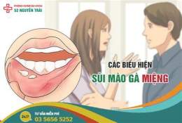 tính năng nổi bật sùi mào gà ở lưỡi giai đoạn đầu