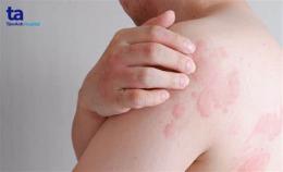 tính năng nổi bật trị da gà dưới nách