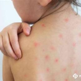 trẻ sốt kèm nổi da gà