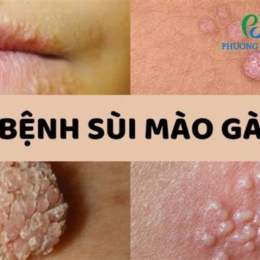 tri benh sui mao ga o benh vien da lieu