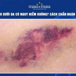 tụ máu dưới da chân gà